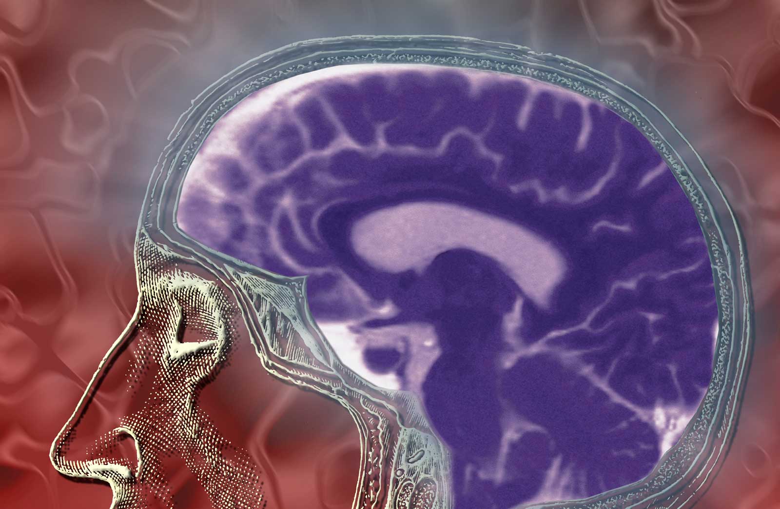 Neurocitomas: qué son, síntomas y opciones de tratamiento