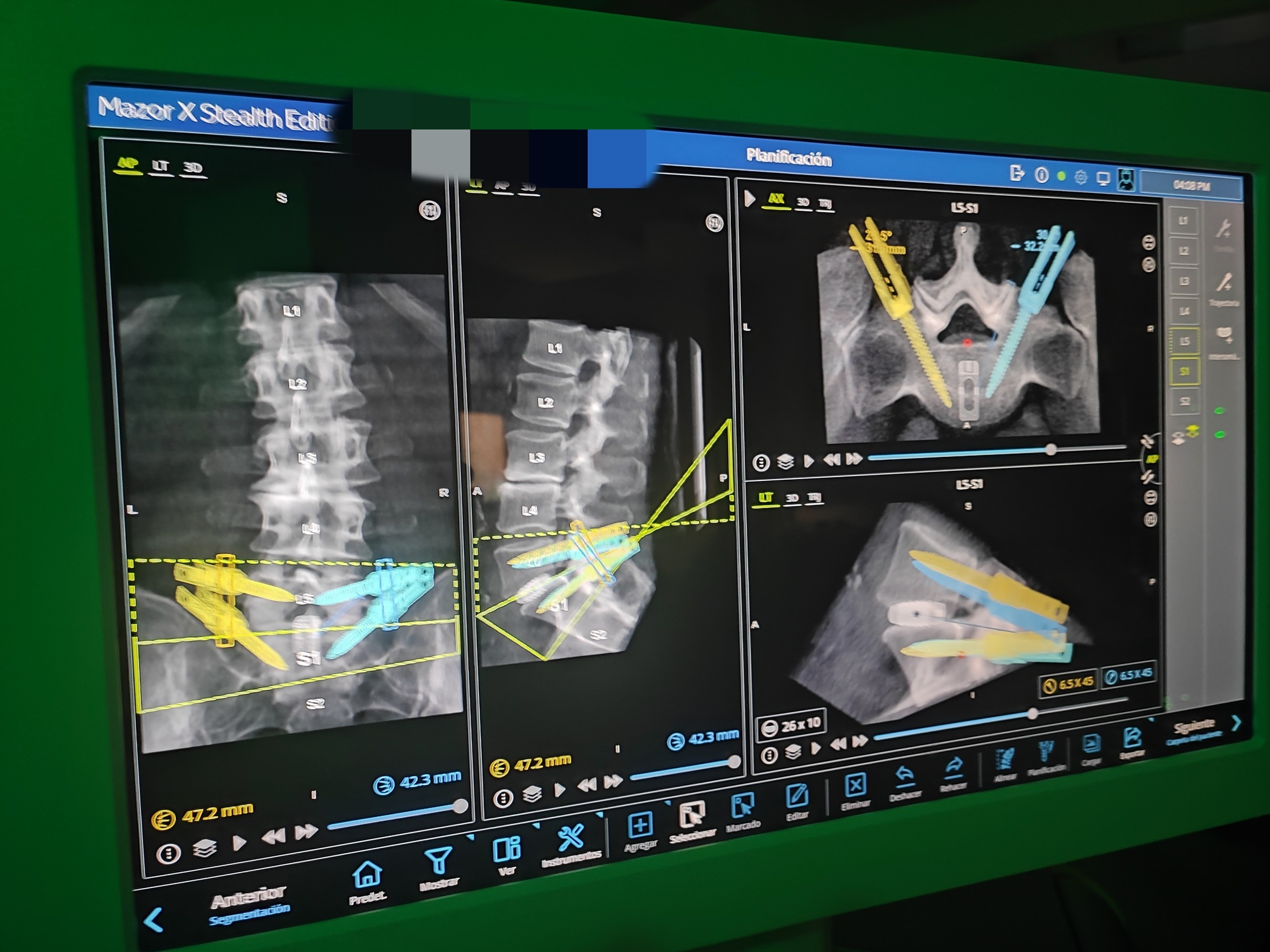 monitor cirugía robótica columna